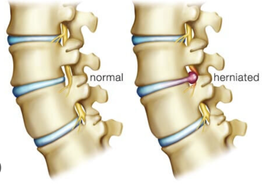 A Comprehensive Guide to Herniated Disk Treatment